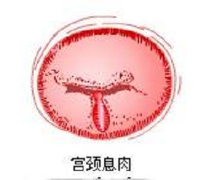 宫颈息肉