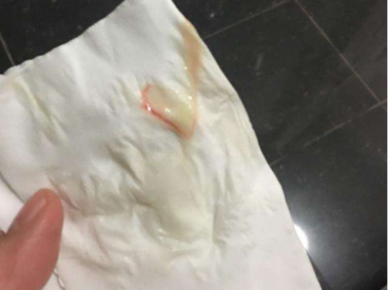 白带血丝 白带异常 分泌物 白带出血