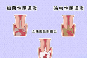 阴道炎 妇科炎 妇科炎症