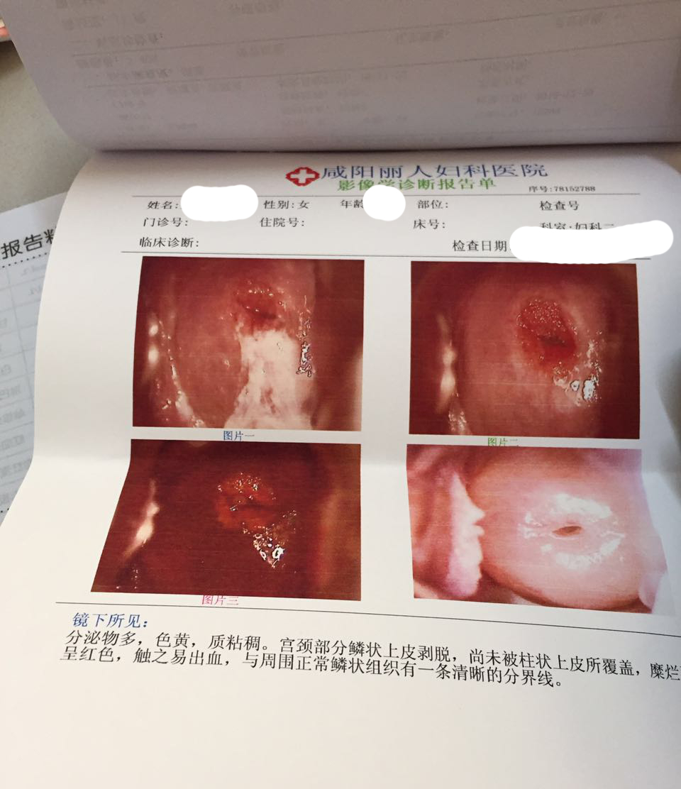 宫颈囊肿